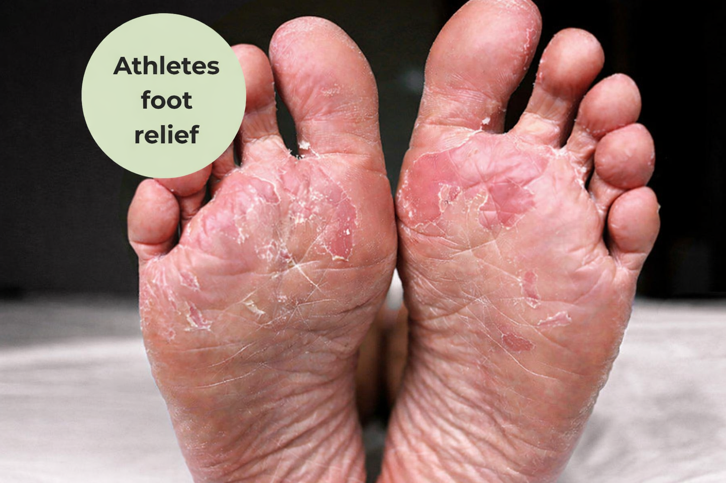 Revive Antifungal Therapeutic Cream (formerly Anti-Fungal Topical Cream)