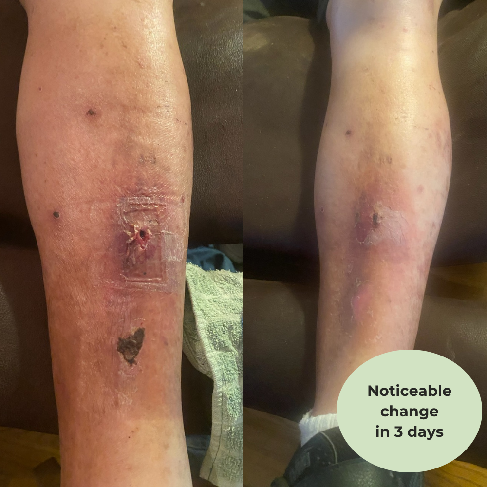 Peripheral Neuropathy MSM Cream